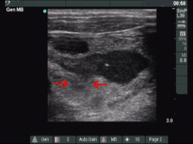 Right lobe, longitudinal scan